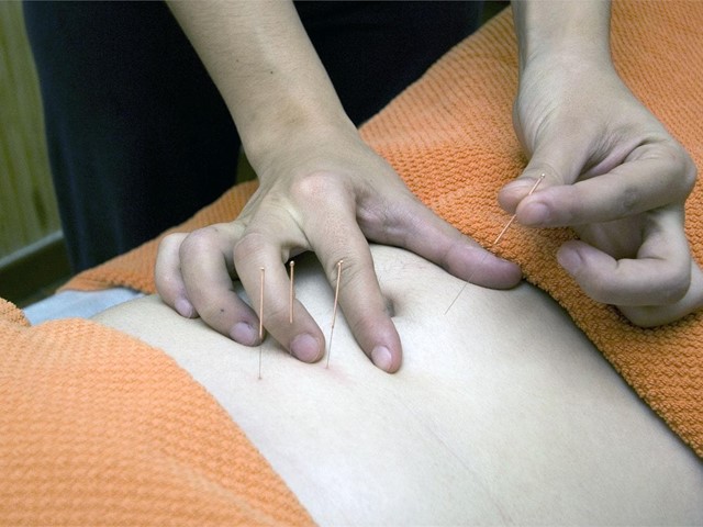 Acupuntura en Santiago: beneficios y características de esta técnica