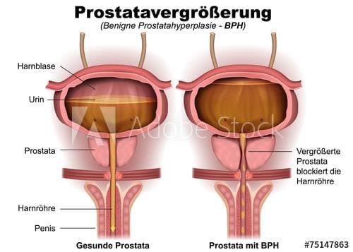 Hiperplasia Benigna de Próstata ¿y eso que es lo que es? - Imagen 1