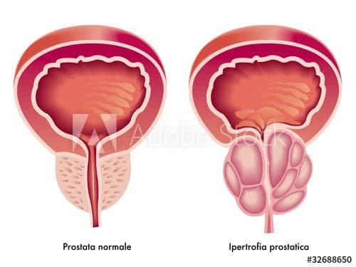 Hiperplasia Benigna de Próstata ¿y eso que es lo que es? - Imagen 2